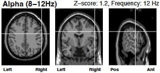 alpha wave brain scan after neurofeedback